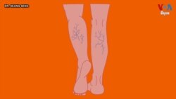 Hello VOA សុខភាព៖ កំណកឈាមក្នុងសរសៃឈាមវ៉ែនជើងអាចបង្កឱ្យស្លាប់យ៉ាងទាន់ហន់