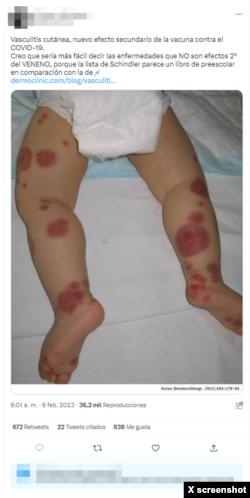 Publicación en Twitter donde se asegura que la vasculitis cutánea es un "nuevo" efecto secundario de la vacuna contra la COVID-19.