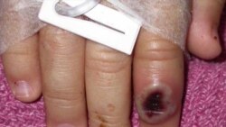 Sala de Redacción: OPS LATAM viruela símica
