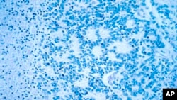 ARCHIVO: Esta fotografía de diciembre de 1993, tomada con un microscopio electrónico y facilitada por el Instituto Nacional del Cáncer de Estados Unidos muestra un neuroblastoma típico con formación de rosetas. 