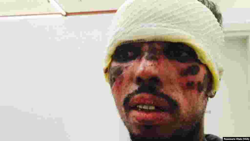 ፊቱን በእሳት ወሮበሎች ያቃጠሉት ፍልሰተኛ በጣልያን ሚላን ከተማ መቀበያ ማእከል