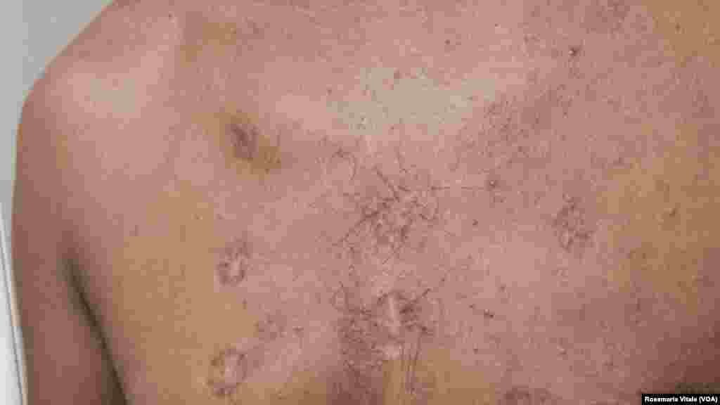 አብ ጉዕዞ ሊብያ-አውሮጳ ብነጋዶ ደቂ-ሰባት ዝተቀጥቀጠ አብ አካላቱ በሰላ ዘለዎ ስእሊ እቲ ግዳይ አብ ኢጣልያ -ሚላን ስደተኛታት ካብ ዝሕክም ኢጣልያዊ ዝተረኽበ'ዩ