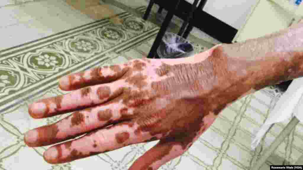 ወሮበሎች እጁን ያቃጠሉት ፍልሰተኛ በጣልያን ሚላን ከተማ የህክምና መቀበያ ማእከል