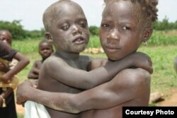 Health specialists say lack of vitamin A can cause blindness in children (Photo Courtesy - Light for the World)