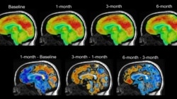 Quiz - Electrical Device in Brain Might Help with Depression