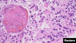 FILE - A high-magnification image from a 2012 glioblastoma case is seen as an example in this College of American Pathologists image released from Northfield, Ill., July 20, 2017. 