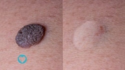 Moles da Skin Tags wasu lalurori na fata masu kama da tsiro wadanda a hankali suke girma, ba sa lahani sai idan sun fara kaikayi ko zafi