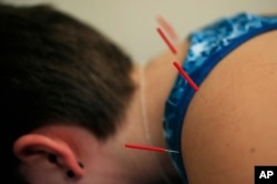 Acupuncture needles are applied on Sarah Taylor's back during an acupuncture treatment at the Children's National Medical Center in Washington, Monday, 2018.