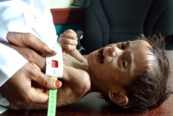 FILE - Ahmed Abdo Salem, a 2-year-old Yemeni child displaced by conflict and suffering from malnutrition (weighing only five kilograms), is measured at a health clinic in the war-ravaged western Hodeida province, Feb. 15, 2021.