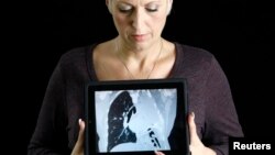 Una mujer sostiene el escán del pulmón de su hija. No todos los fumadores deben ser sometidos a tomografías computarizadas.