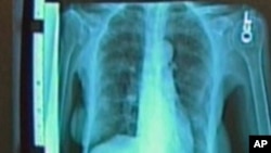 An X-ray showing lung cancer.
